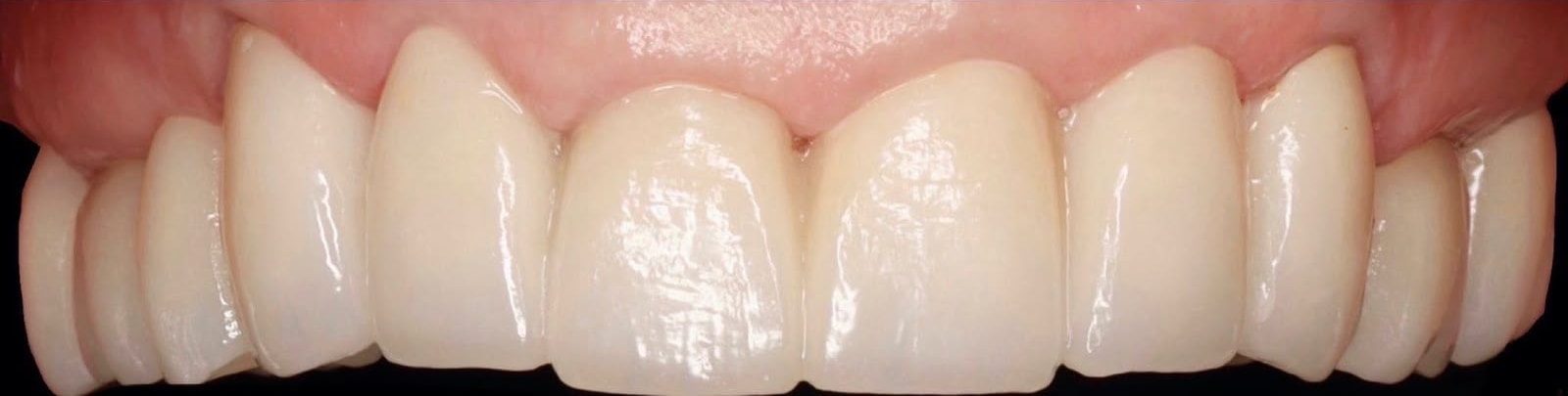 After treatment