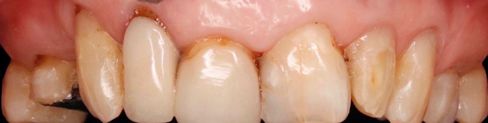 Before treatment